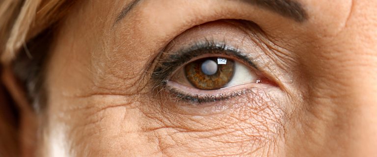 Cataracts Causes & Symptoms | Common Eye Problems | Opticians Ayr